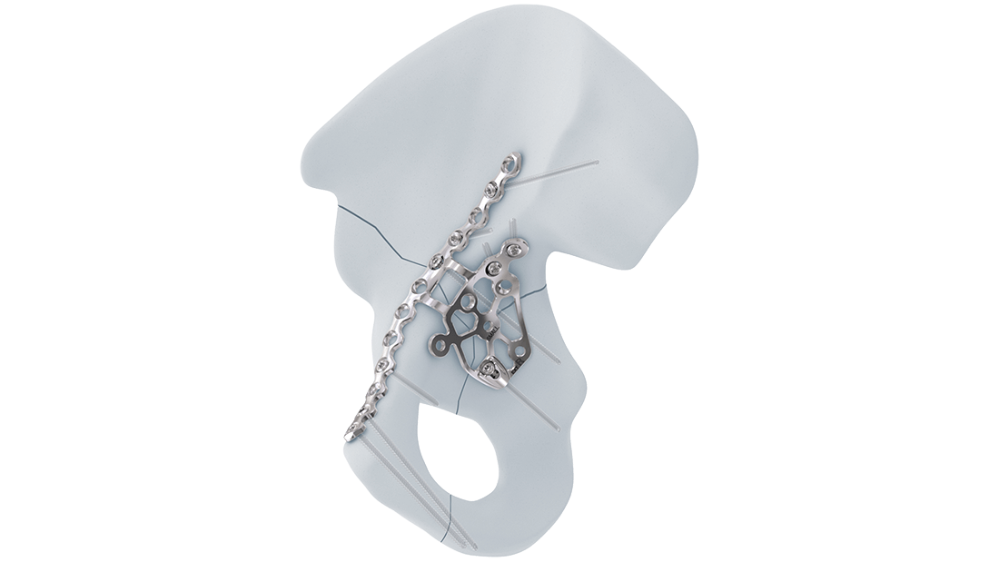 Intrapelvic Acetabular System | Products | DePuy Synthes